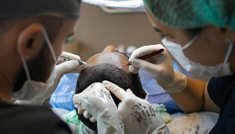 Greffe de cheveux : anesthésie locale sans douleur