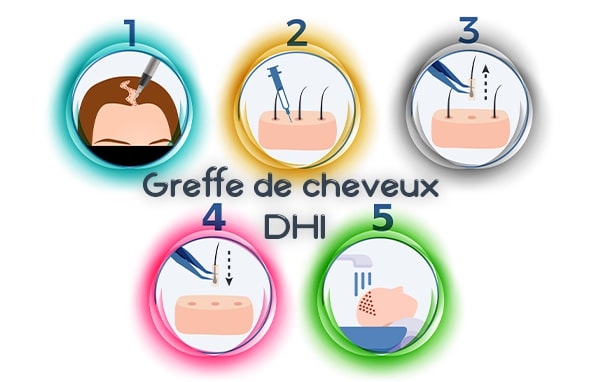 Greffe de Cheveux DHI