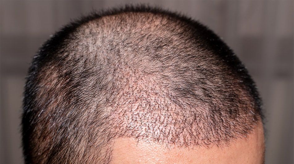 FUE unit extraction